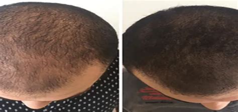 scalp micropigmentation sa|Everything You Need to Know About Scalp Micropigmentation.
